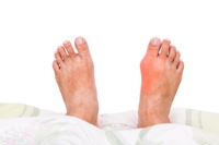 Can Gout Be Linked To Foods That Are Eaten?